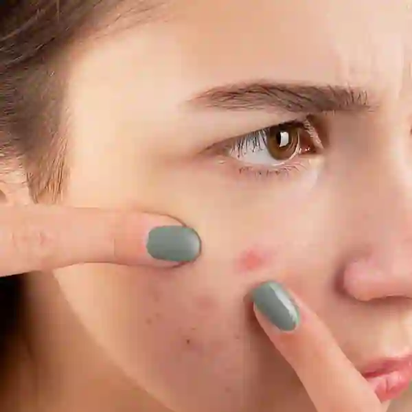 Peau Acnéique Algérie